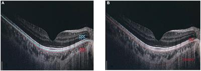 Structural, blood flow and functional changes in the macular area and the expression of aqueous humor factors in myopia